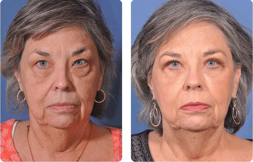 Woman’s face before and after - Upper Lid Blepharoplasty And Brow Lift treatment, front view, patient 10