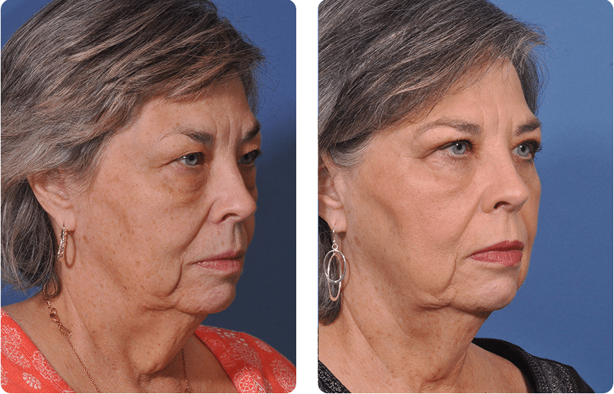 Woman’s face before and after - Upper Lid Blepharoplasty And Brow Lift treatment, r-side oblique view, patient 10