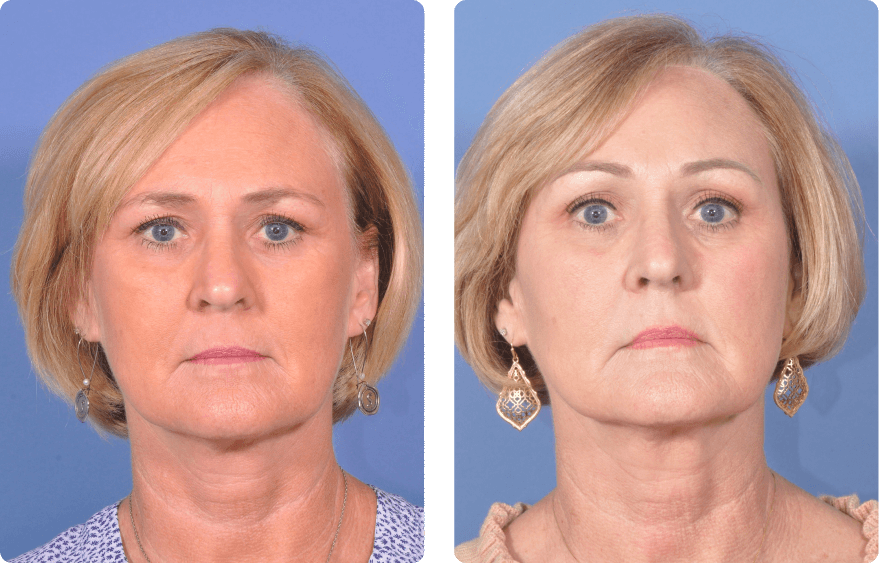 Woman’s face before and after - Upper Lid Blepharoplasty And Brow Lift treatment, front view, patient 2