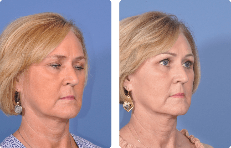 Woman’s face before and after - Upper Lid Blepharoplasty And Brow Lift treatment, r-side oblique view, patient 2