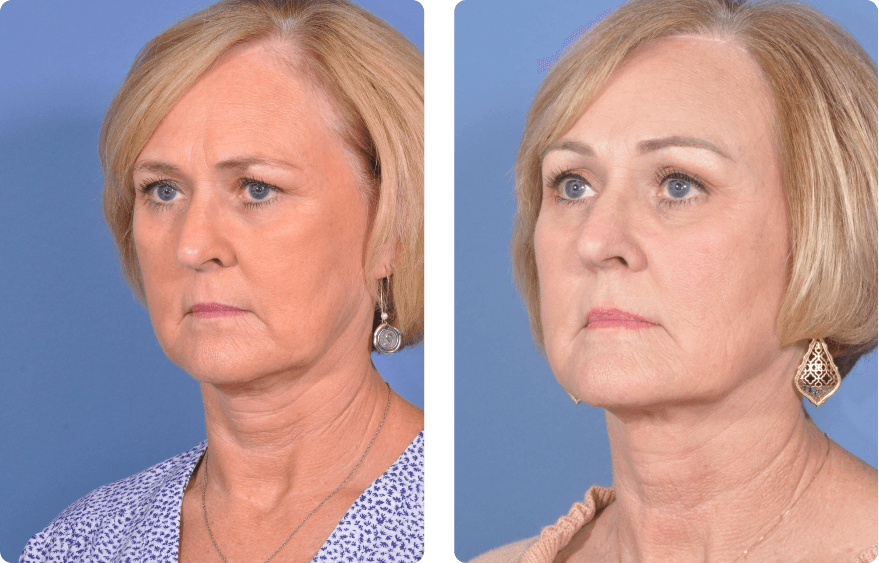 Woman’s face before and after - Upper Lid Blepharoplasty And Brow Lift treatment, l-side oblique view, patient 2