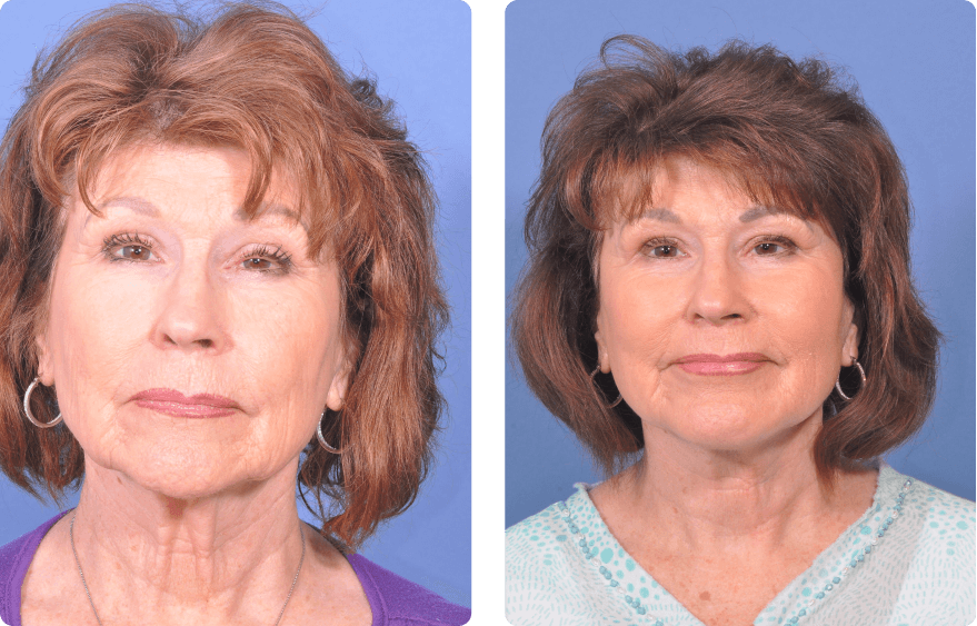 Woman’s face before and after - Upper Lid Blepharoplasty And Brow Lift treatment, front view, patient 3