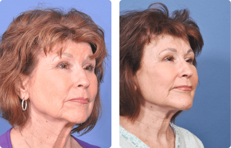 Woman’s face before and after - Upper Lid Blepharoplasty And Brow Lift treatment, r-side oblique view, patient 3