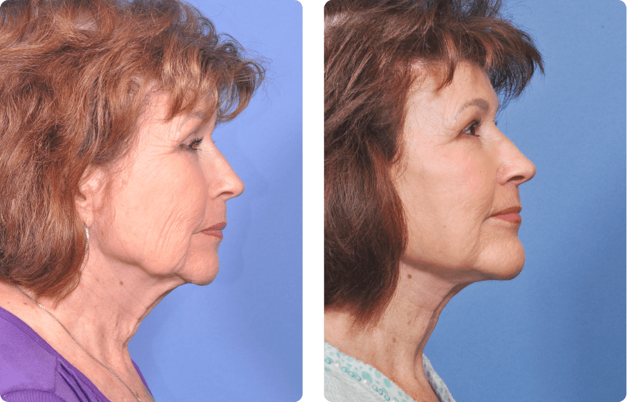 Woman’s face before and after - Upper Lid Blepharoplasty And Brow Lift treatment, r-side view, patient 3