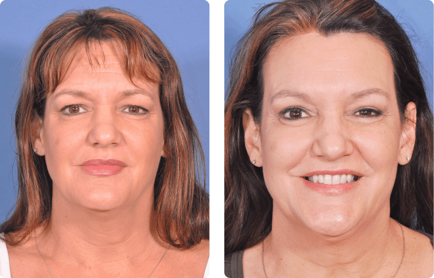 Woman’s face before and after - Upper Lid Blepharoplasty And Brow Lift treatment, front view, patient 4