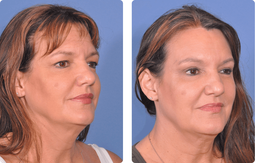 Woman’s face before and after - Upper Lid Blepharoplasty And Brow Lift treatment, r-side oblique view, patient 4