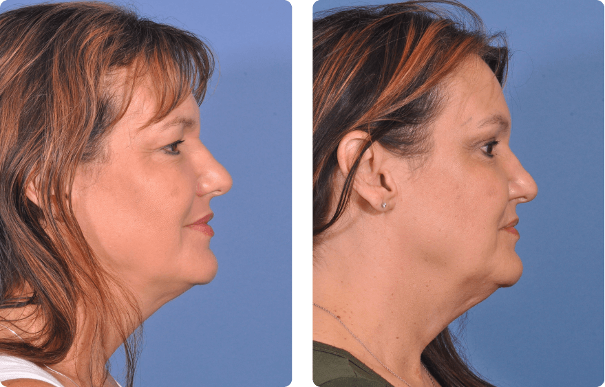 Woman’s face before and after - Upper Lid Blepharoplasty And Brow Lift treatment, r-side view, patient 4