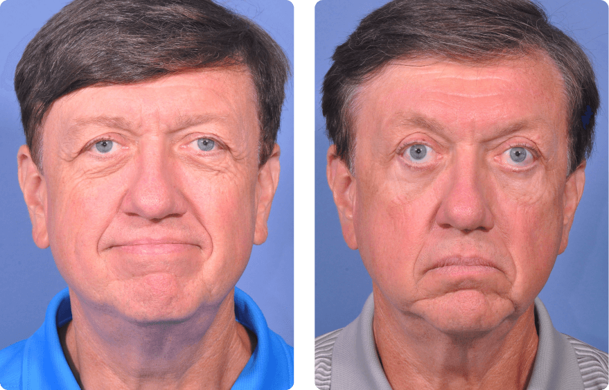 Male face before and after - Upper Lid Blepharoplasty And Brow Lift treatment, front view, patient 5