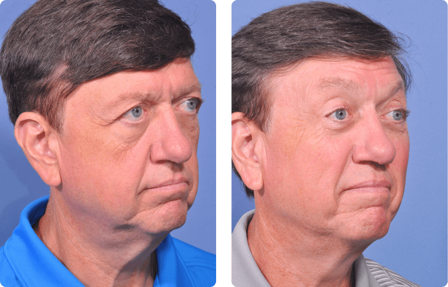 Male face before and after - Upper Lid Blepharoplasty And Brow Lift treatment, r-side oblique view, patient 5
