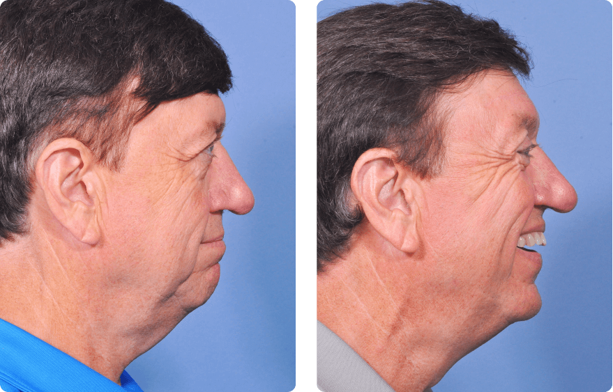 Male face before and after - Upper Lid Blepharoplasty And Brow Lift treatment, r-side view, patient 5