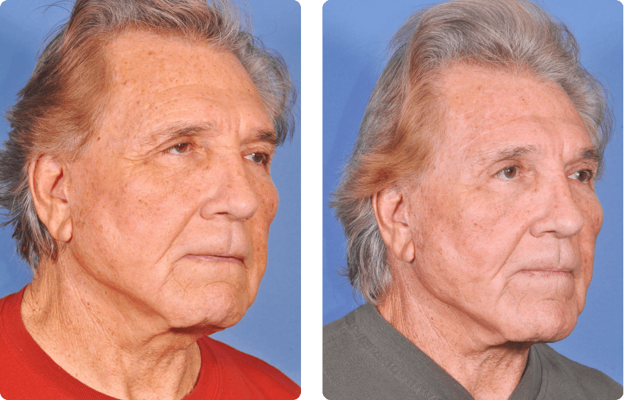Male face before and after - Upper Lid Blepharoplasty And Brow Lift treatment, r-side oblique view, patient 6