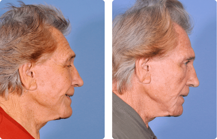 Male face before and after - Upper Lid Blepharoplasty And Brow Lift treatment, r-side view, patient 6