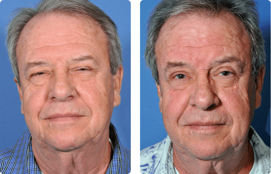 Male face before and after - Upper Lid Blepharoplasty And Brow Lift treatment, front view, patient 8