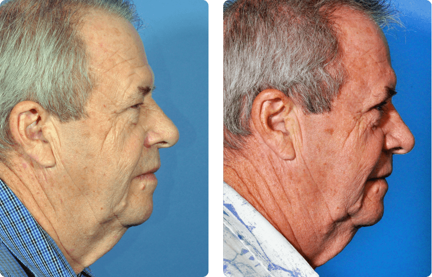 Male face before and after - Upper Lid Blepharoplasty And Brow Lift treatment, r-side view, patient 8