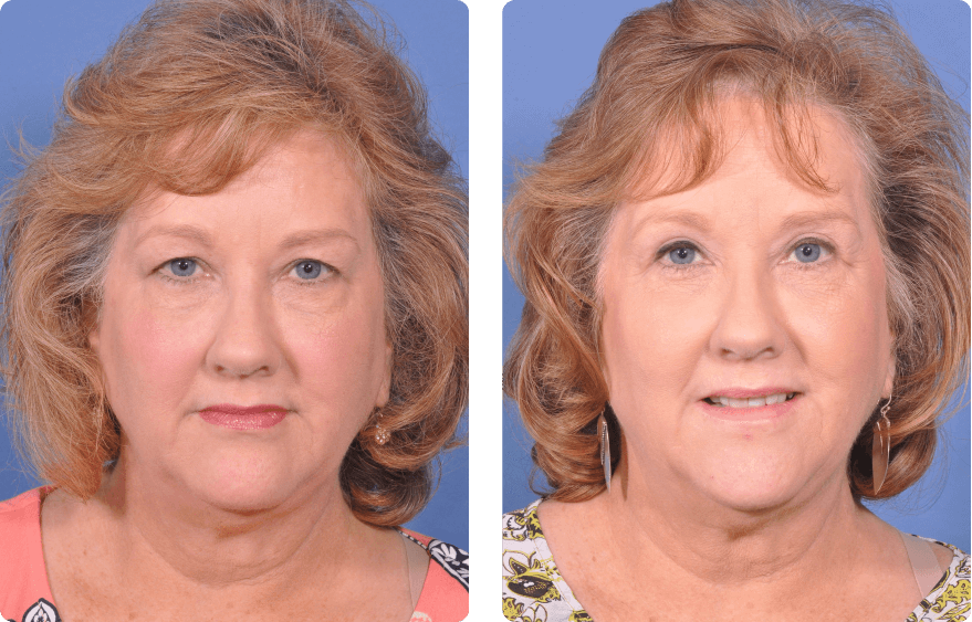 Woman’s face before and after - Upper Lid Blepharoplasty And Brow Lift treatment, front view, patient 9