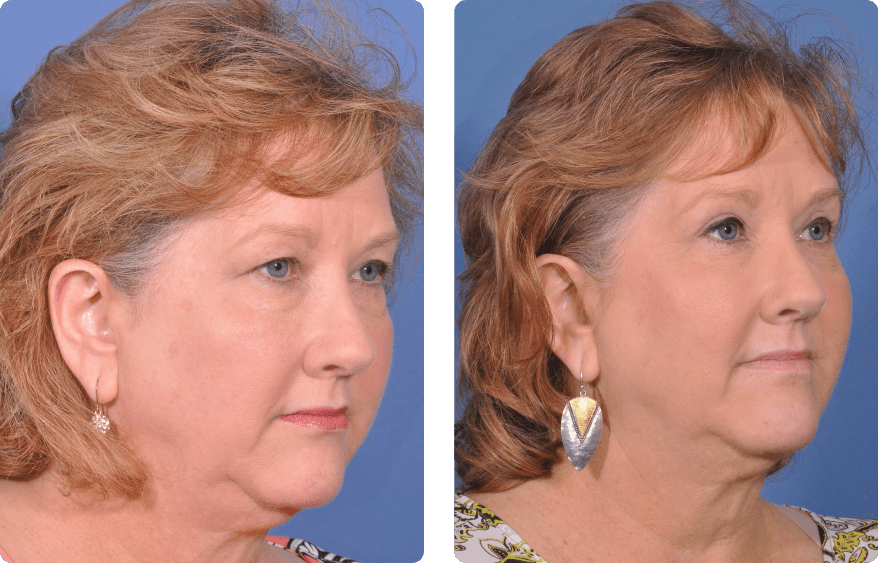 Woman’s face before and after - Upper Lid Blepharoplasty And Brow Lift treatment, r-side oblique view, patient 9