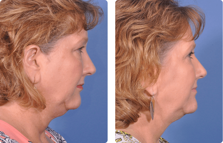 Woman’s face before and after - Upper Lid Blepharoplasty And Brow Lift treatment, r-side view, patient 9