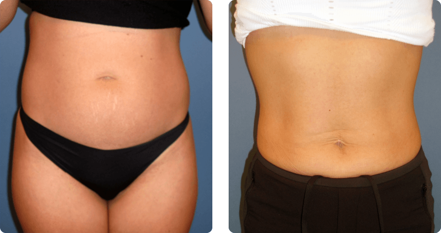 Photo of the patient’s body before and after BodyTite treatment. Set 1. Patient 2