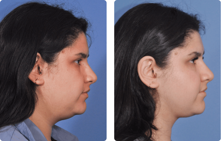 Woman’s face, before and after Evoke treatment, r-side view, patient 1