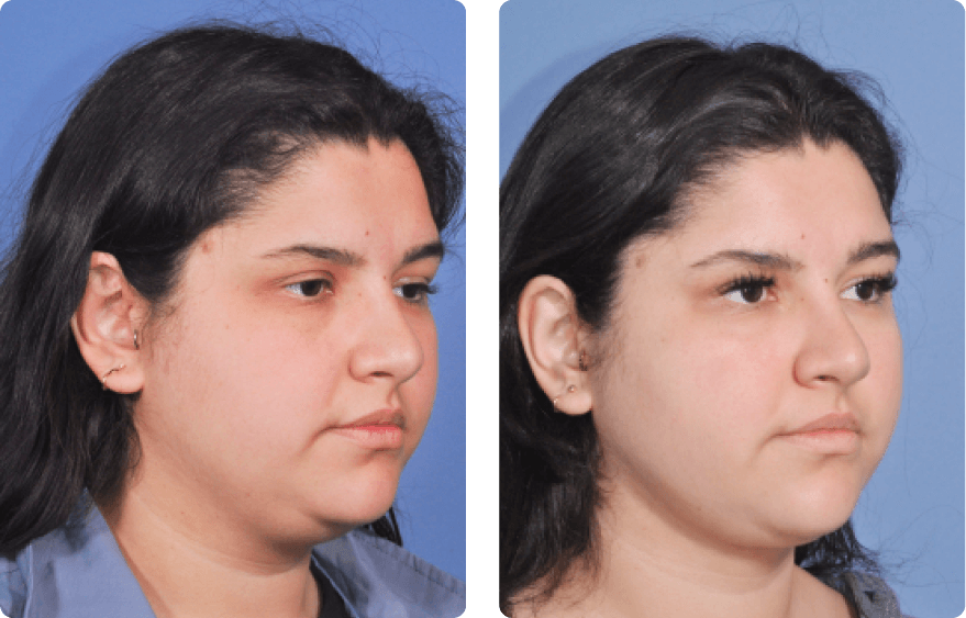 Woman’s face, before and after Evoke treatment, r-side oblique view, patient 3