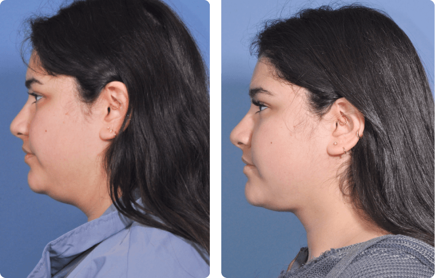 Woman’s face, before and after Evoke treatment, l-side view, patient 1