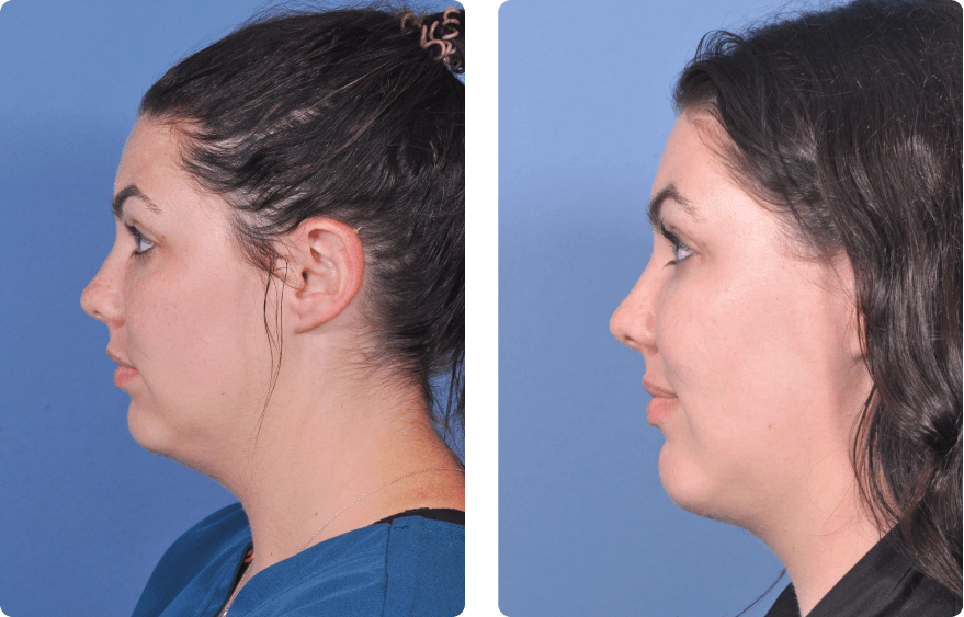 Woman’s face, before and after Evoke treatment, l-side view, patient 2