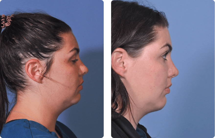 Woman’s face, before and after Evoke treatment, r-side view, patient 12