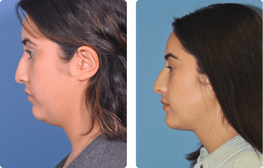 Woman’s face, before and after Evoke treatment, l-side view, patient 3