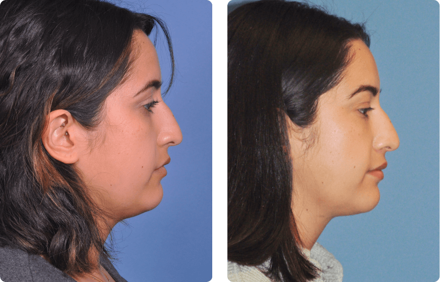 Woman’s face, before and after Evoke treatment, r-side view, patient 3