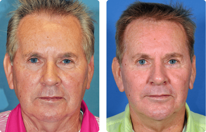 Male face before and after - Facelift treatment, front view, patient 10