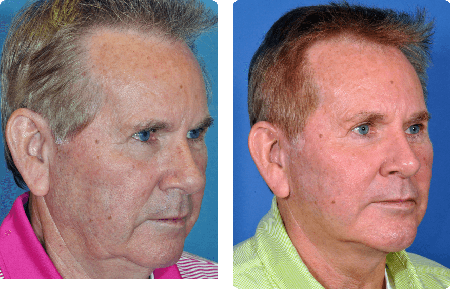 Male face before and after - Facelift treatment, r-side oblique view, patient 10
