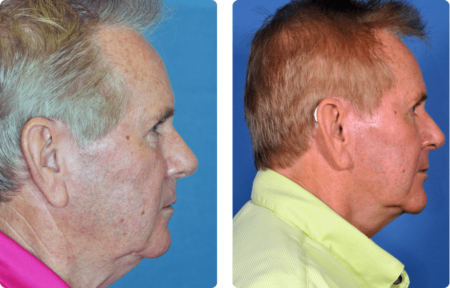 Male face before and after - Facelift treatment, r-side view, patient 10