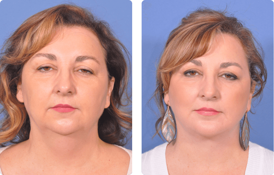 Woman’s face before and after - Facelift treatment, front view, patient 11