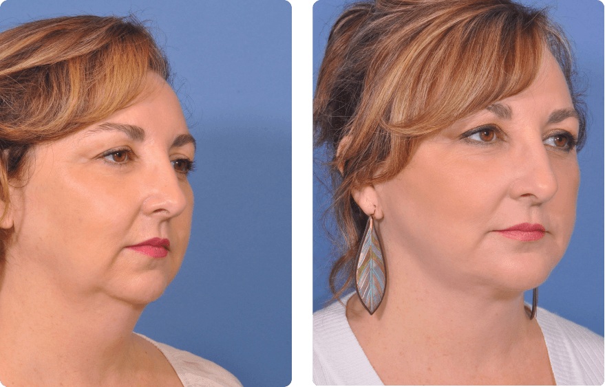 Woman’s face before and after - Facelift treatment,r-side oblique view, patient 11