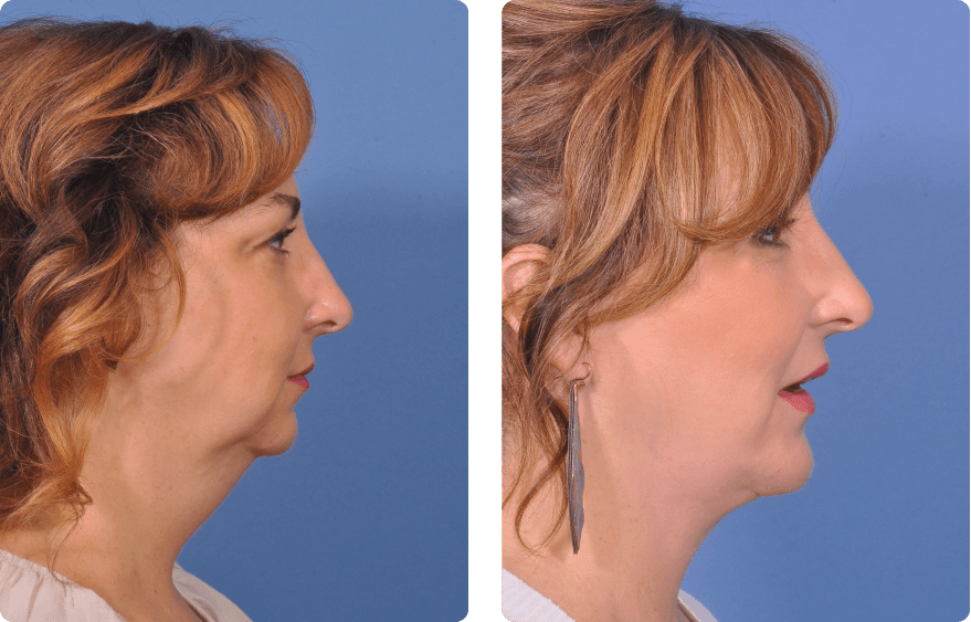 Woman’s face before and after - Facelift treatment,r-side view, patient 11