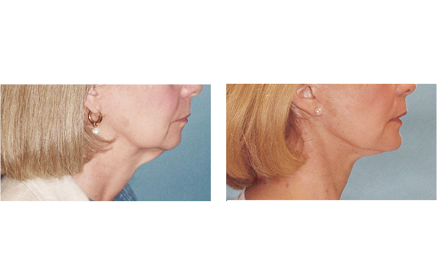 Woman’s face before and after - Facelift treatment, r-side view, patient 12