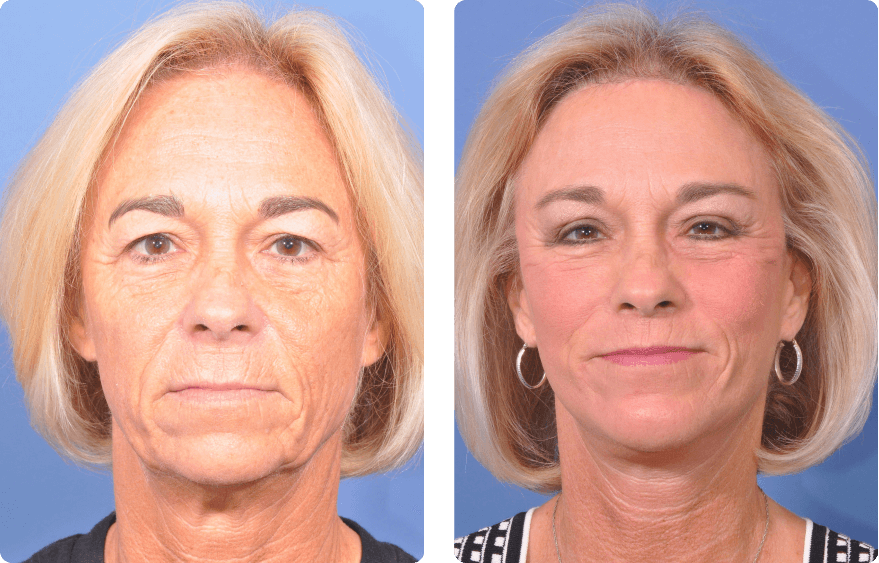 Woman’s face before and after - Facelift treatment, front view, patient 9