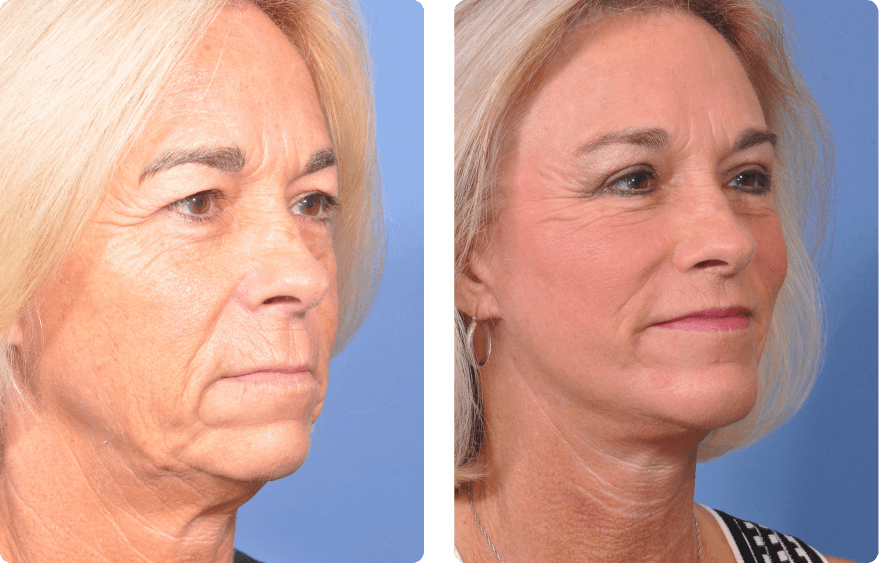 Woman’s face before and after - Facelift treatment,r-side oblique view, patient 9