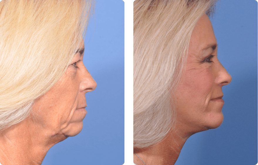 Woman’s face before and after - Facelift treatment,r-side view, patient 9