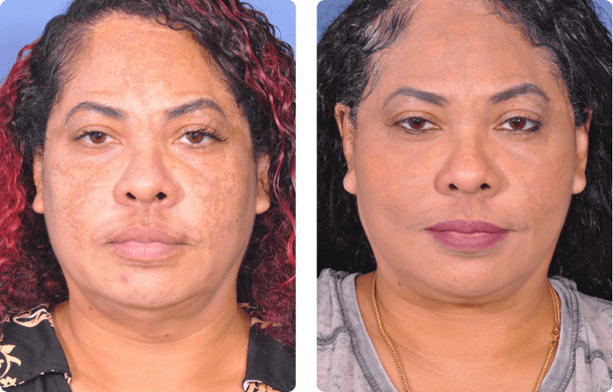 Woman’s face before and after - Lasers & Energy Based Devices treatment,front view, patient 2