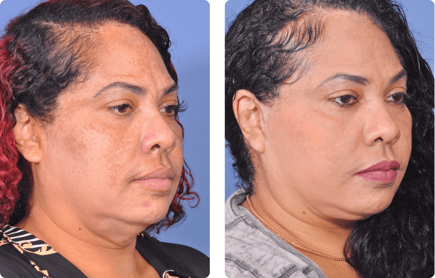 Woman’s face before and after - Lasers & Energy Based Devices treatment,r-side oblique view, patient 2