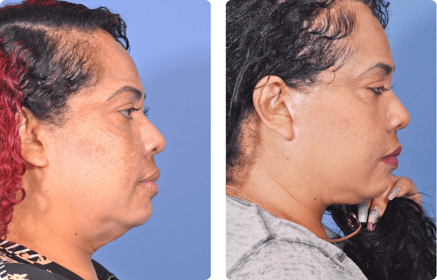 Woman’s face before and after - Lasers & Energy Based Devices treatment,r-side view, patient 2