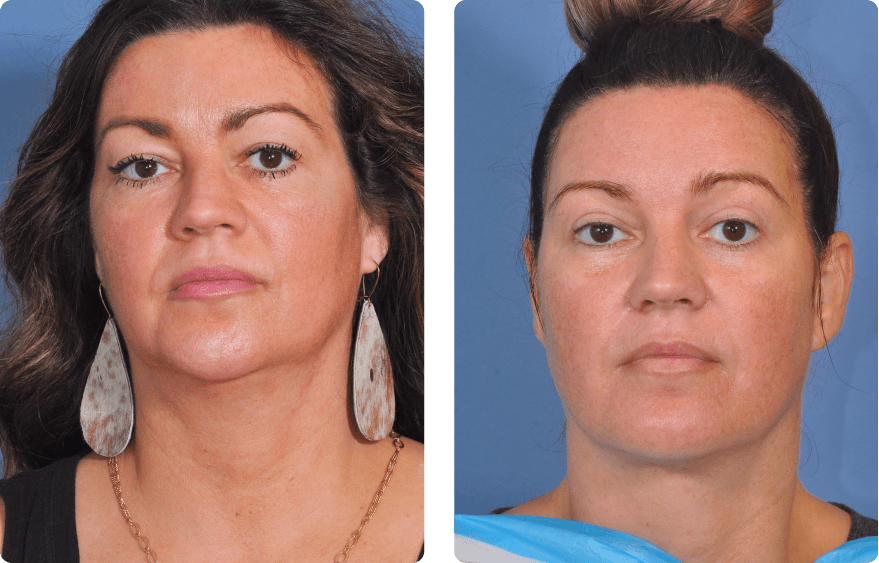 Woman’s face before and after - Lasers & Energy Based Devices treatment,front view, patient 3