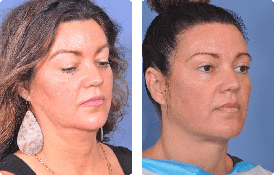Woman’s face before and after - Lasers & Energy Based Devices treatment,r-side oblique view, patient 3