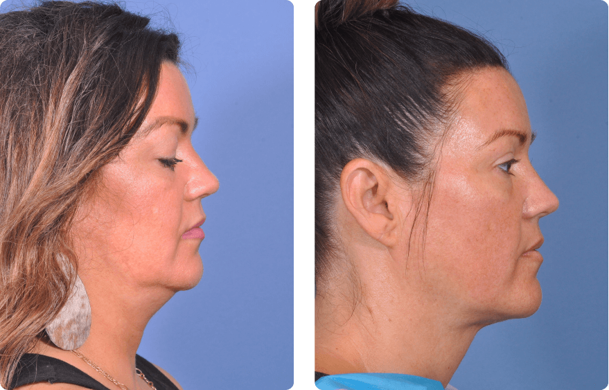 Woman’s face before and after - Lasers & Energy Based Devices treatment,r-side view, patient 3