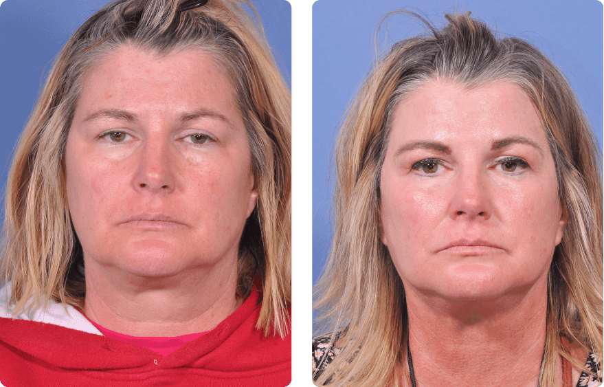 Woman’s face before and after - Lasers & Energy Based Devices treatment,front view, patient 4