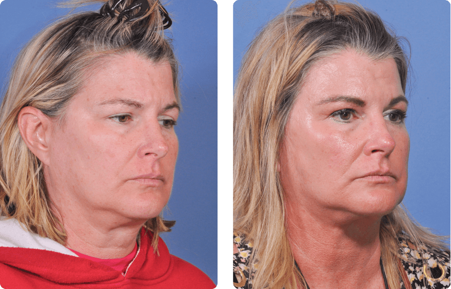 Woman’s face before and after - Lasers & Energy Based Devices treatment,r-side oblique view, patient 4