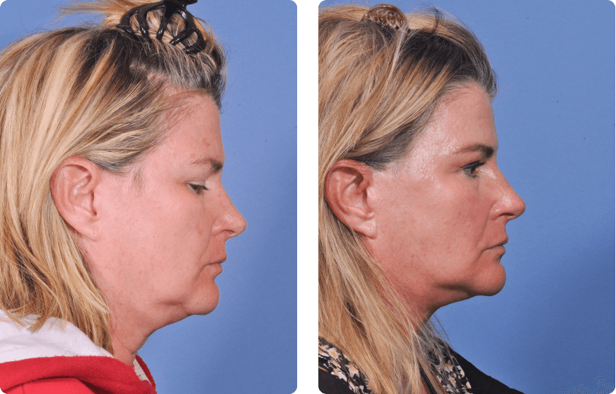 Woman’s face before and after - Lasers & Energy Based Devices treatment,r-side view, patient 4