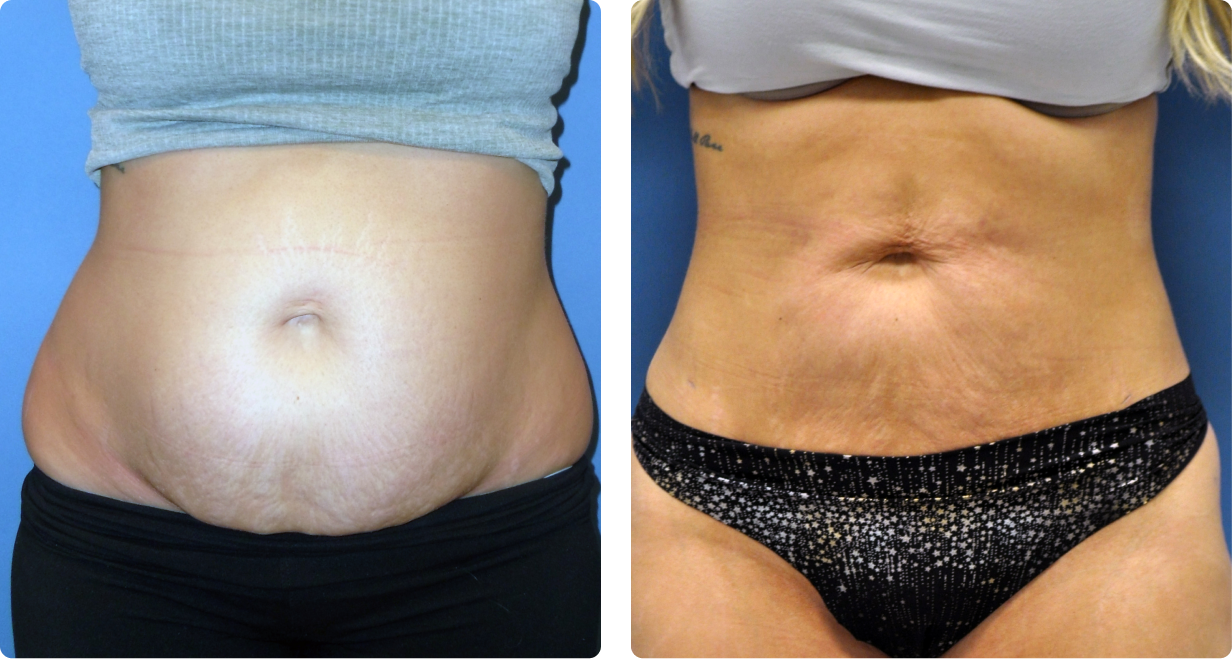Female tummy, before and after BeautiFill treatment, front view - patient 1