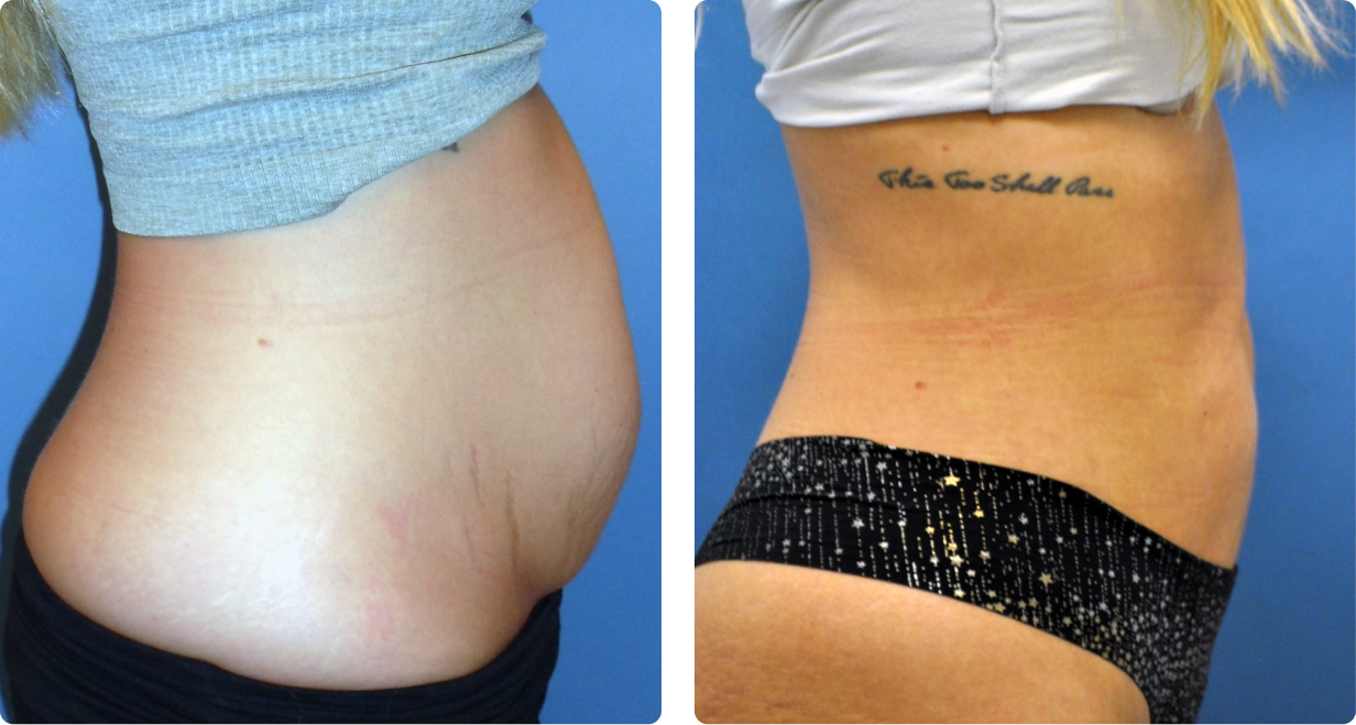 Female tummy, before and after BeautiFill treatment, r-side view - patient 1